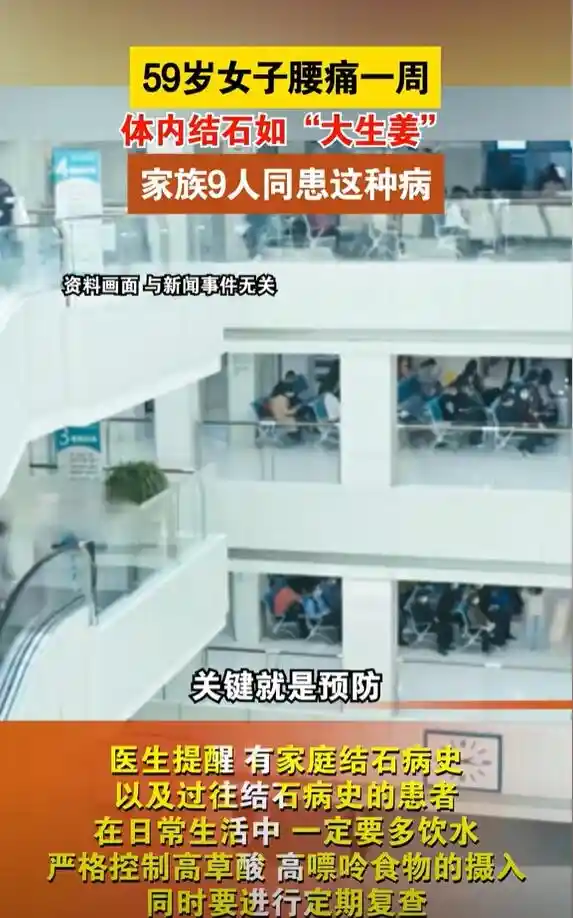 家族9人无一幸免！59岁女子腰痛一周，医生惊现体内长生姜