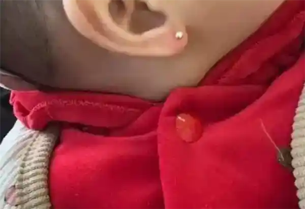 女婴8个月大就穿耳洞？专家警告：易感染风险需警惕