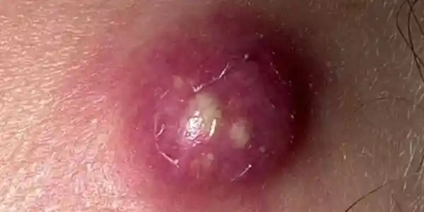 警惕！这种红包竟能引发剧痛与肿胀，硬挤后果不堪设想