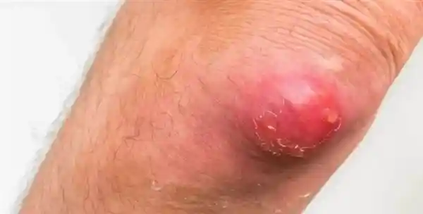 警惕！这种红包竟能引发剧痛与肿胀，硬挤后果不堪设想