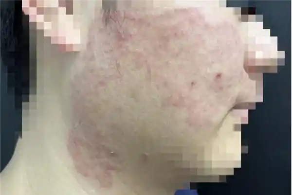 《小伙用擦脚巾擦脸染上脚气！专家警示：这些习惯可能损害你的健康》